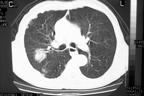 APROVADA NOVA DROGA PARA CÂNCER DE PULMÃO APROVADA NOVA DROGA PARA CÂNCER DE PULMÃO